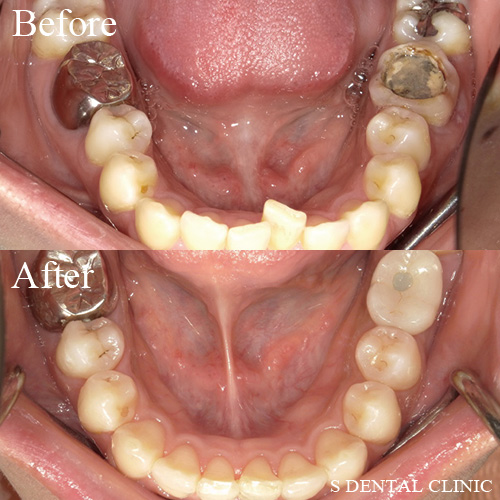 矯正治療による咬合治療を伴ったインプラント治療