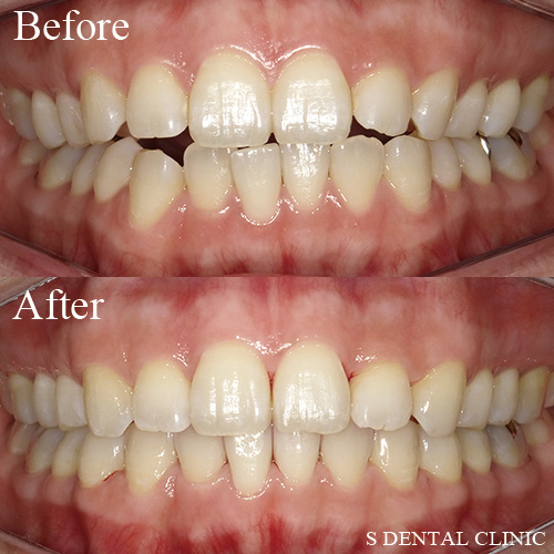 上下の歯の隙間をインビザラインで改善