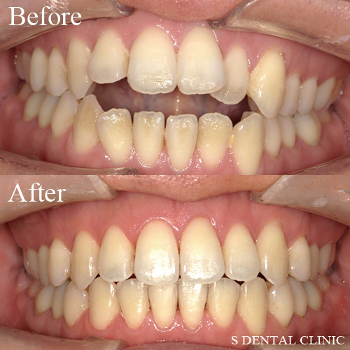 噛み合わない前歯の見た目・機能面の改善
