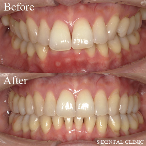 前歯の張り出しと傾斜した奥歯の改善