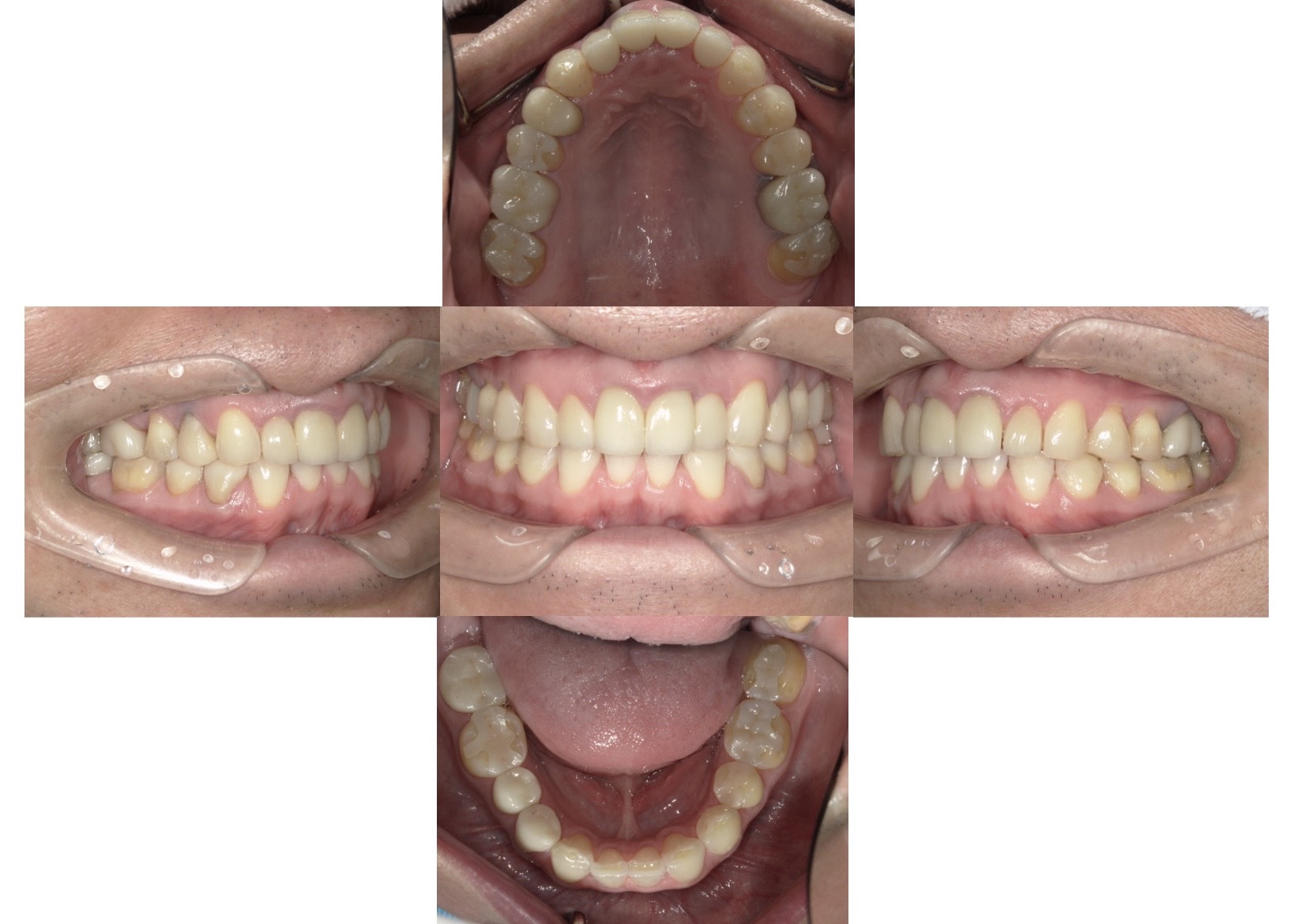 インビザライン（マウスピース矯正）と補綴治療を行なった症例 画像