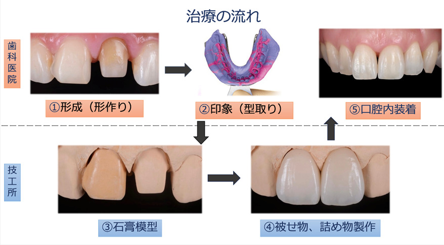 「型取り」の重要性について① 画像