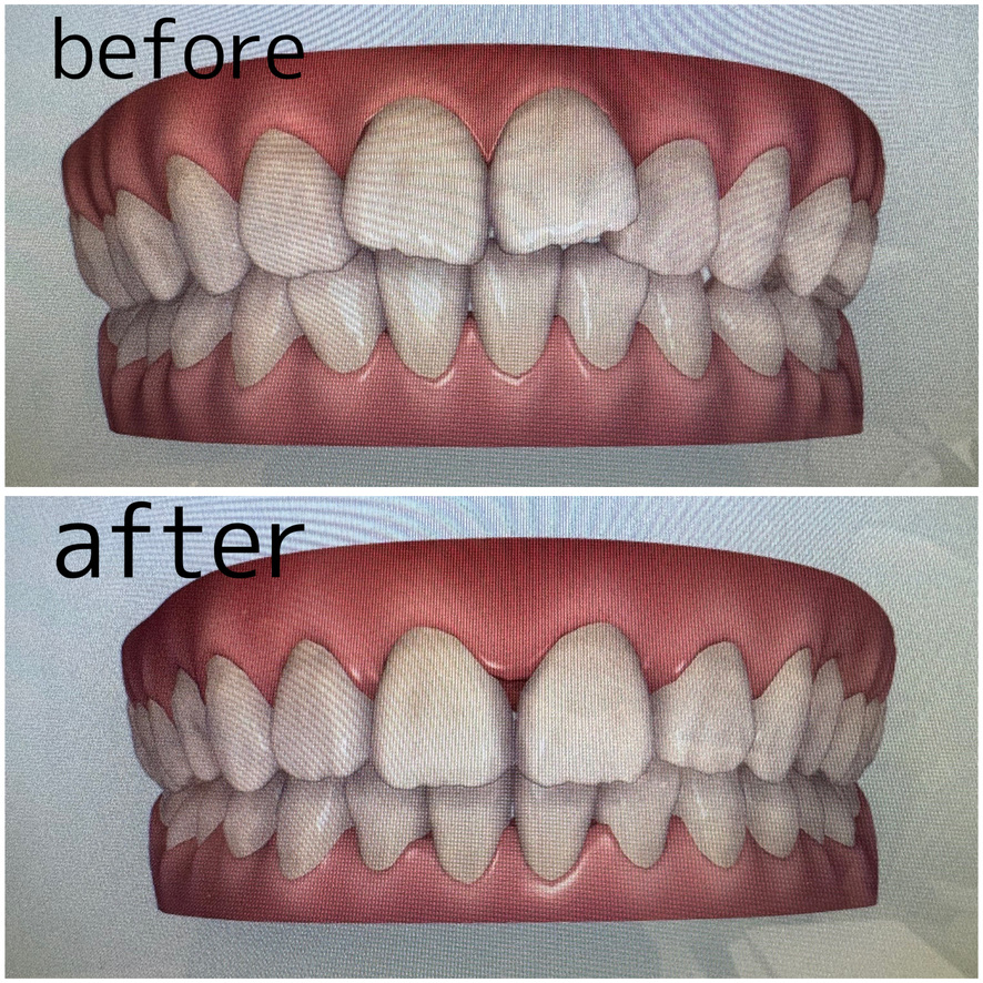 インビザライン（マウスピース矯正）の精密診断について 画像