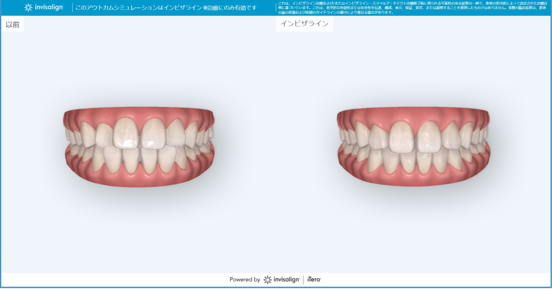インビザライン　iTero（口腔内スキャナー）の新機能について① 画像