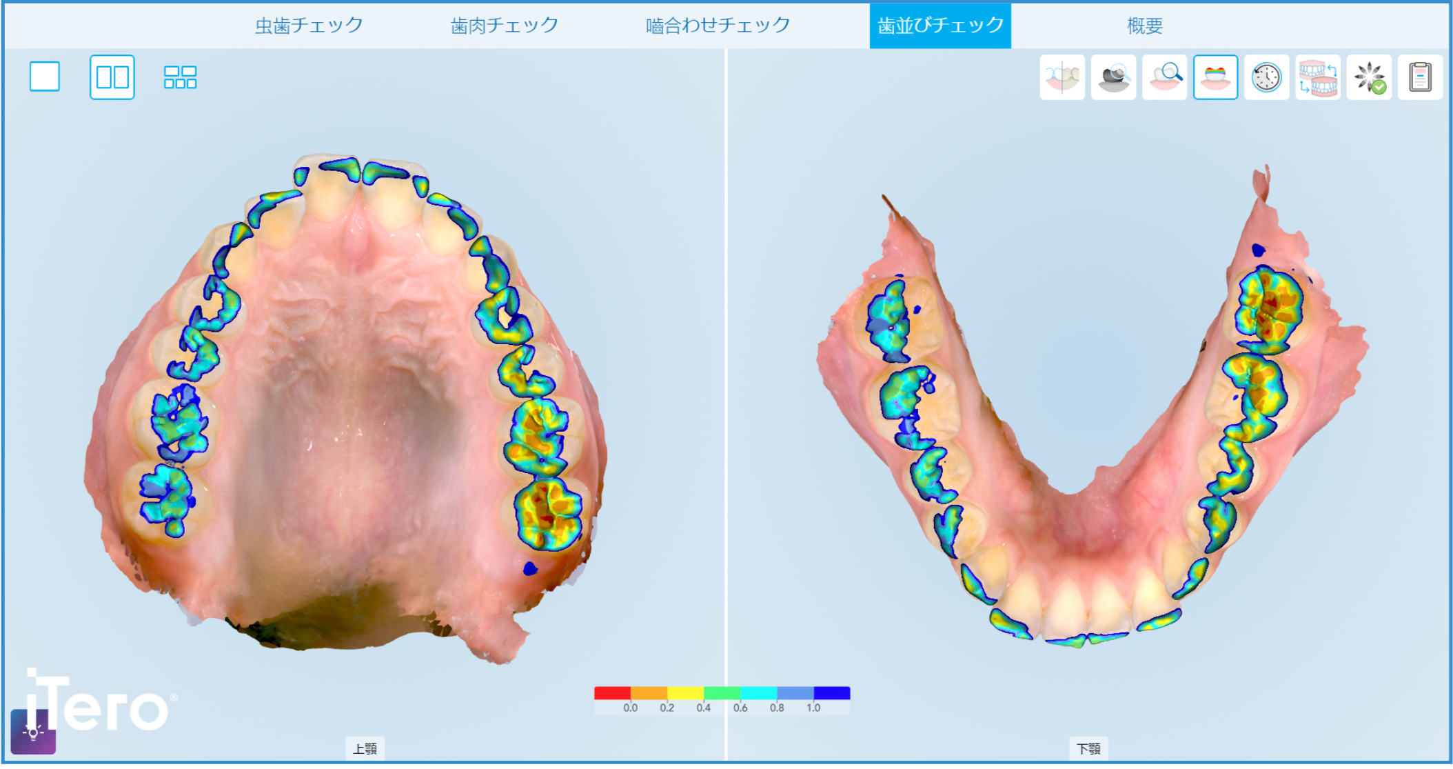 インビザライン　iTero（口腔内スキャナー）の新機能について② 画像