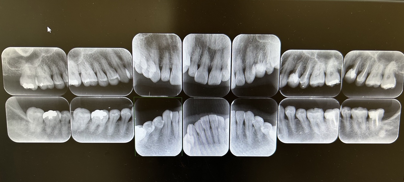 デンタル14枚法（レントゲン写真） 画像