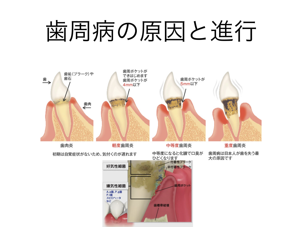 歯周病について🦷 画像