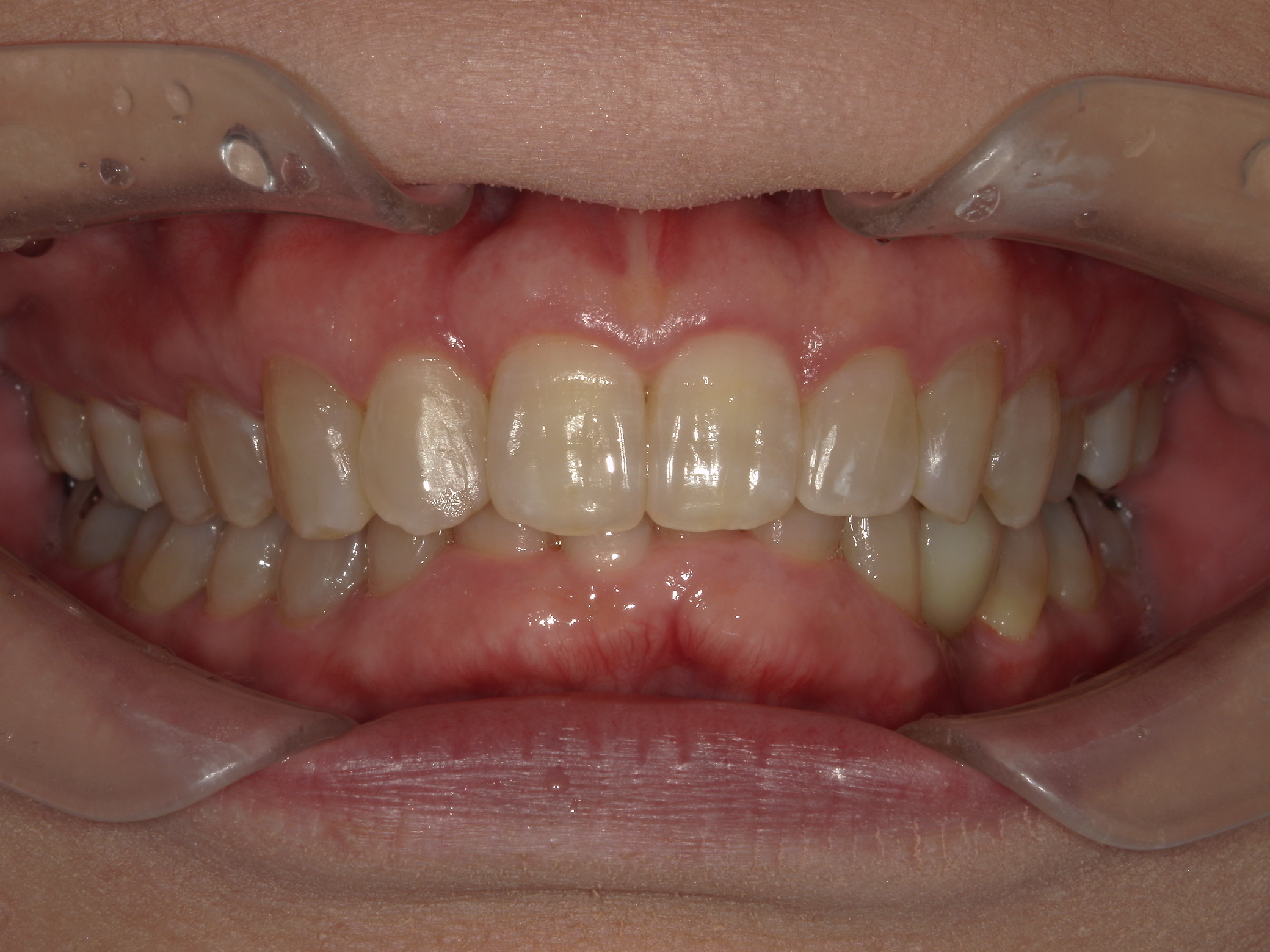 インビザライン矯正とインプラントを併用した症例 画像