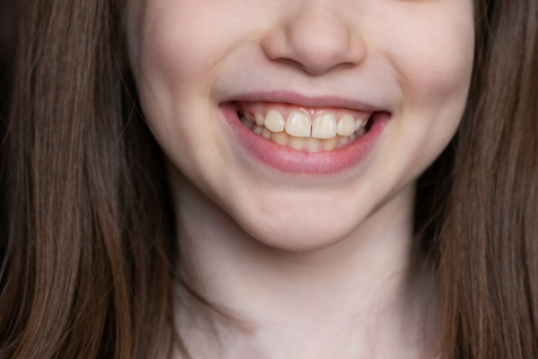 出っ歯（上顎前突）の矯正治療｜原因から治し方まで専門医が徹底解説 画像