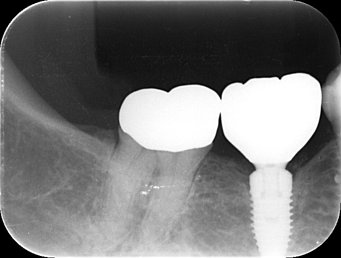 インプラントの経過症例 画像