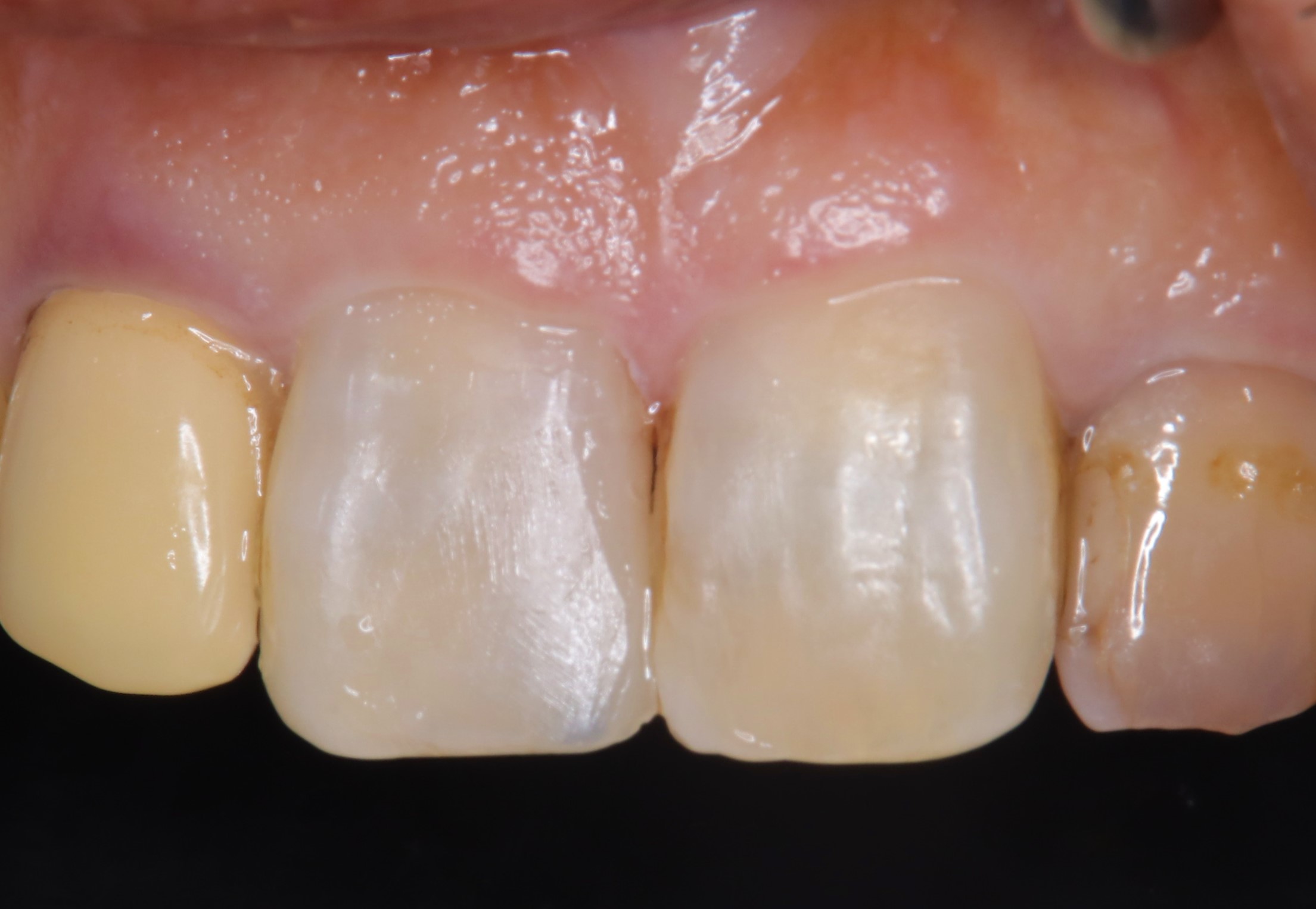 プラスチックの材料でより美しい歯に 画像