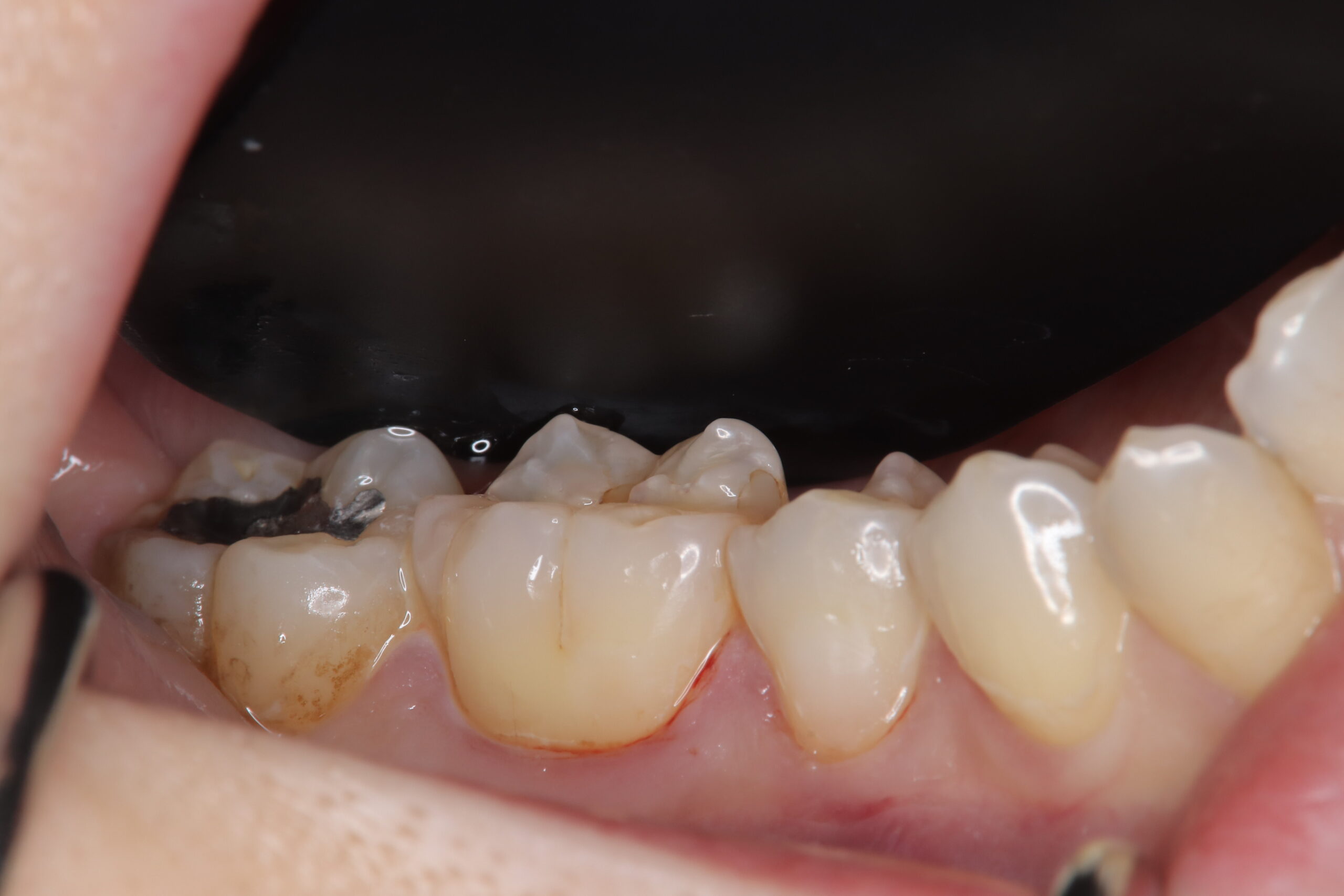 くさび状欠損にグラディアCRをおこなった症例 画像