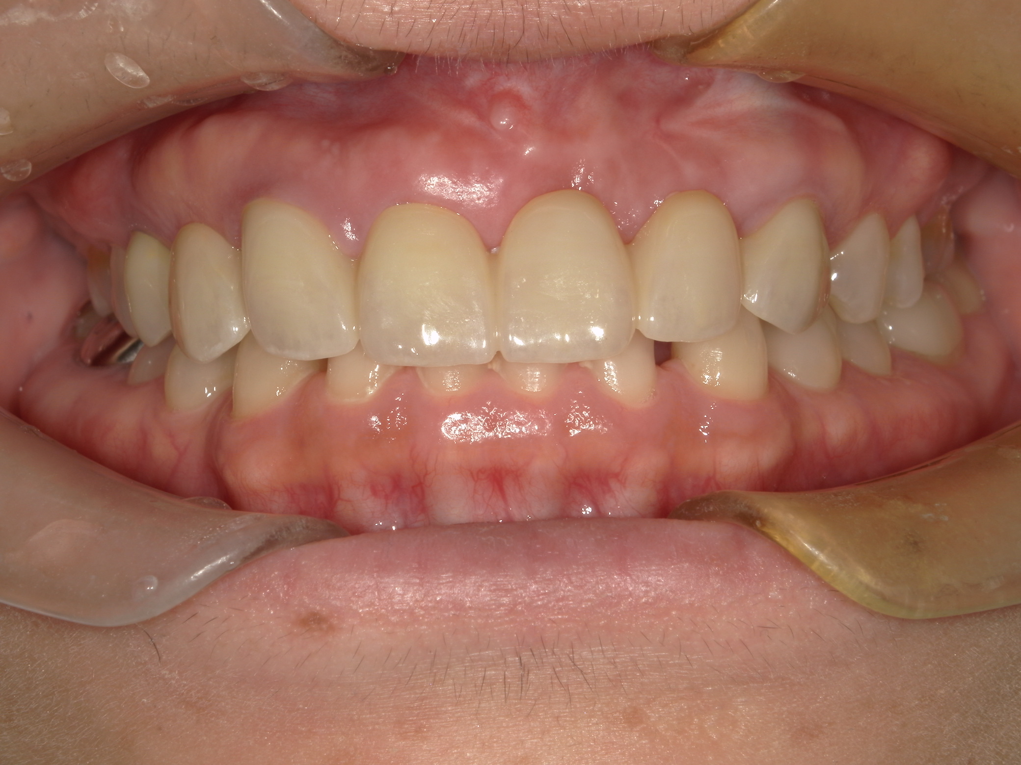 自分の歯を美しく理想的な形へ 画像