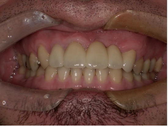 インプラントとブリッジを併用した症例 画像