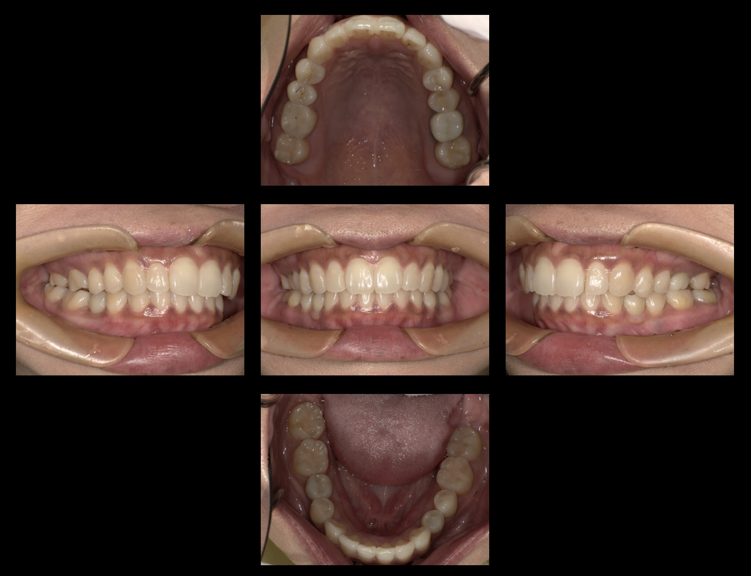 アライナー矯正とインプラント治療を併用した症例 画像